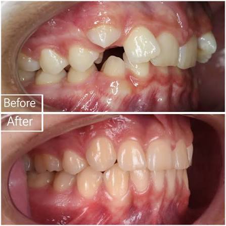 Patient smile transformation 1