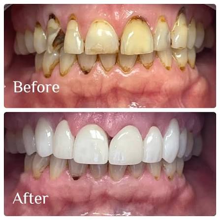 Patient smile transformation 6