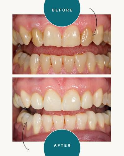 Patient smile transformation 3