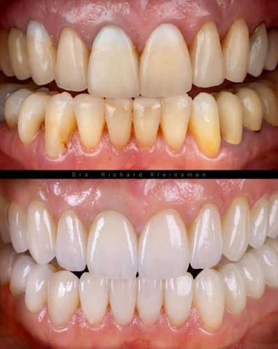 Patient smile transformation 4